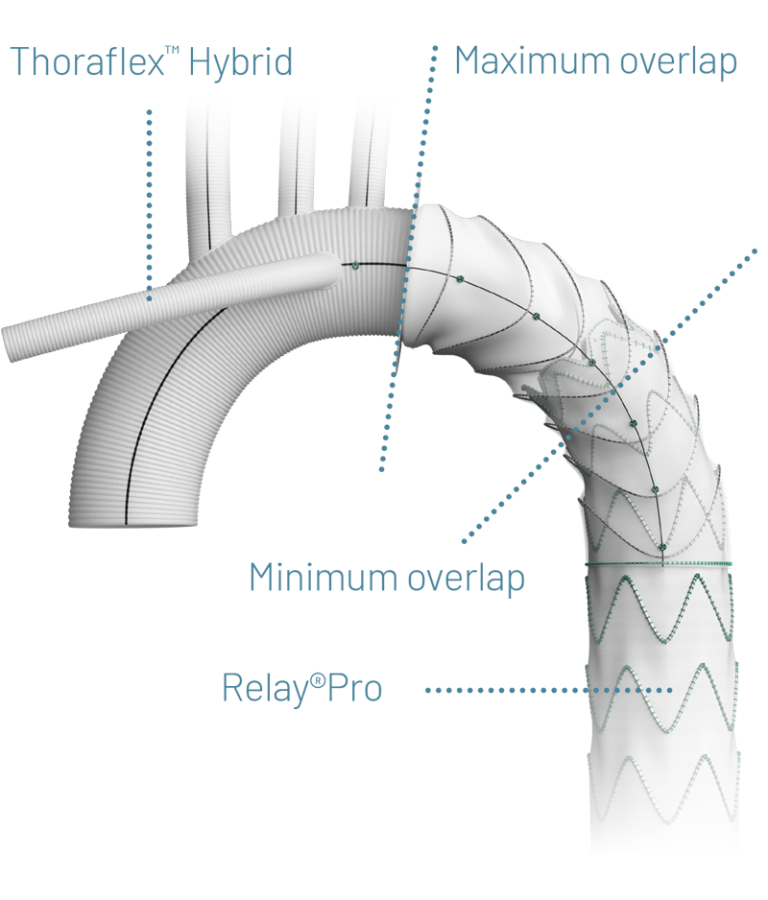 RelayPro & Thoraflex Hybrid