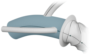 Feature Image of Custom Thoraflex Hybrid - Body