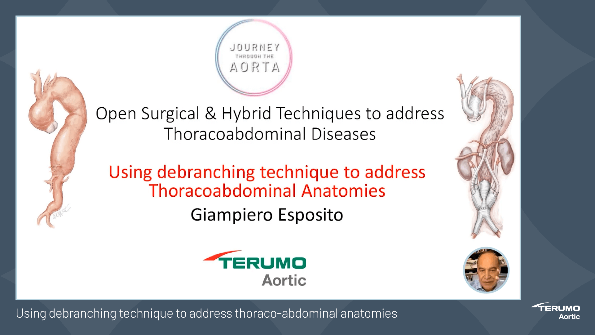 Using debranching technique to address thoracoabdominal anatomies