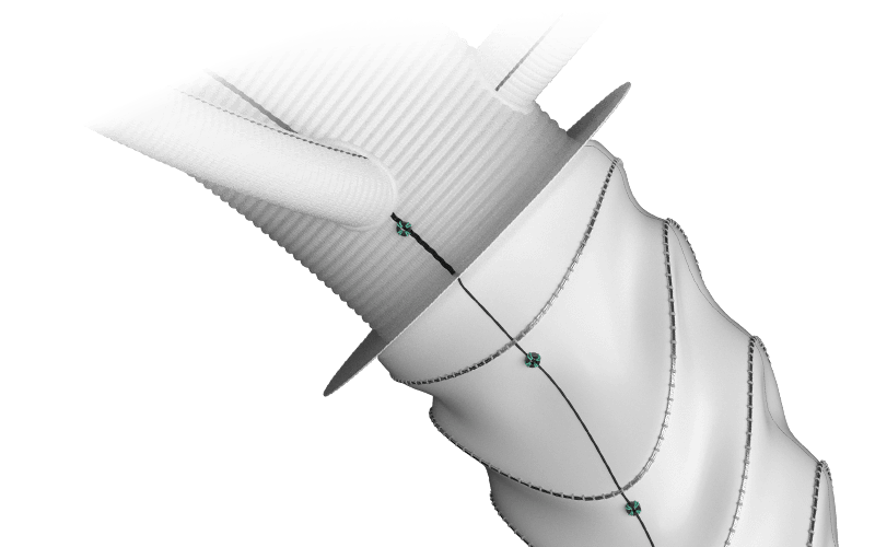 Closeup of Thoraflex Hybrid Siena Collar - Frozen Elephant Trunk Technique (FET)