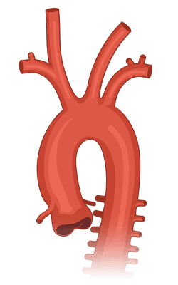 Aorta