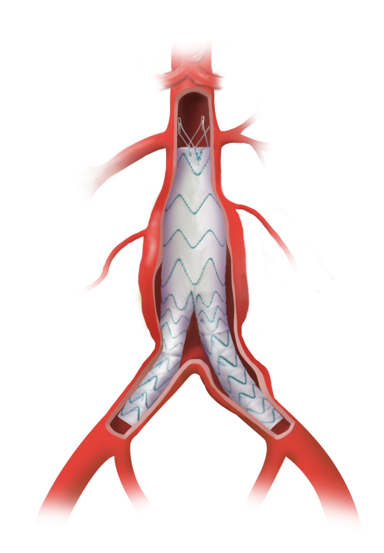 TREO Graft Aorta Full Deflation Aneurysm