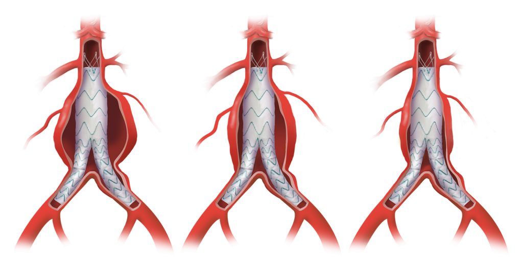 sac regression
